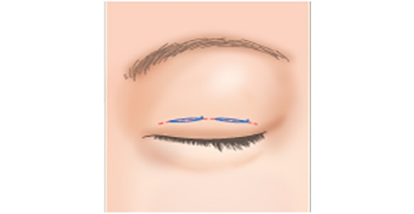皮膚や脂肪が分厚い場合
