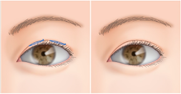 皮膚や脂肪が分厚い場合