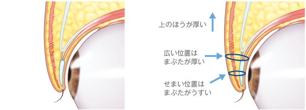 幅広い二重を埋没法で作る場合