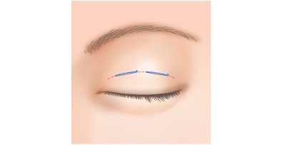 幅広い二重を埋没法で作る場合