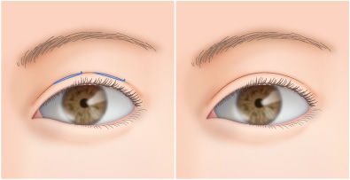 幅広い二重を埋没法で作る場合