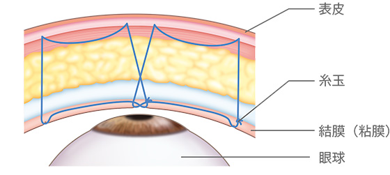 裏留め埋没法 表皮/糸玉/結膜（粘膜）/眼球