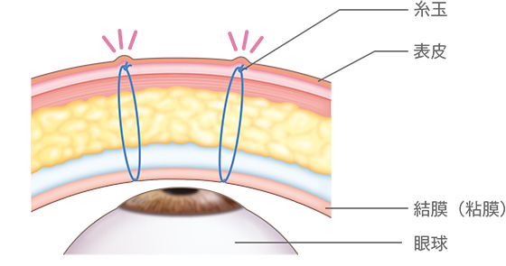 一般的な埋没法 表皮/糸玉/結膜（粘膜）/眼球