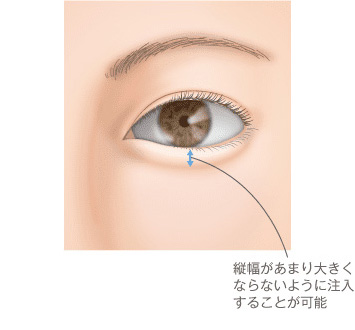 横幅があまり大きくならないように注入可能