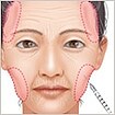 ヒアルロン酸チークヒアル(ヒアルロン酸で頬やこめかみをふっくら)