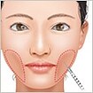 頬をふっくら・ヒアルロン酸注射