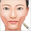 頬をふっくら・脂肪注入