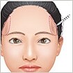 こめかみ形成(ふっくらさせる)