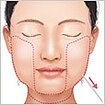 脂肪吸引(頬、あご下)
