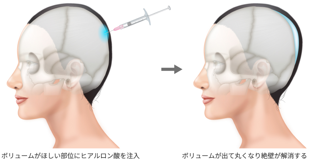 ボリュームがほしい部位にヒアルロン酸を注入→ボリュームが出て丸くなり絶壁が解消する
