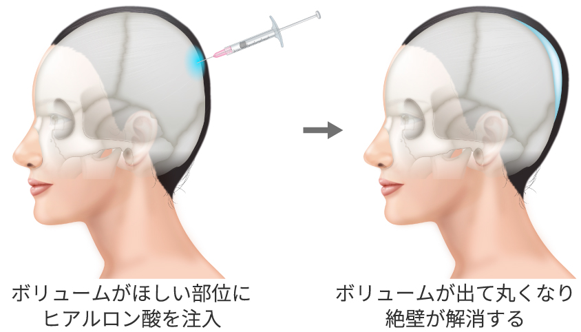 ボリュームがほしい部位にヒアルロン酸を注入→ボリュームが出て丸くなり絶壁が解消する