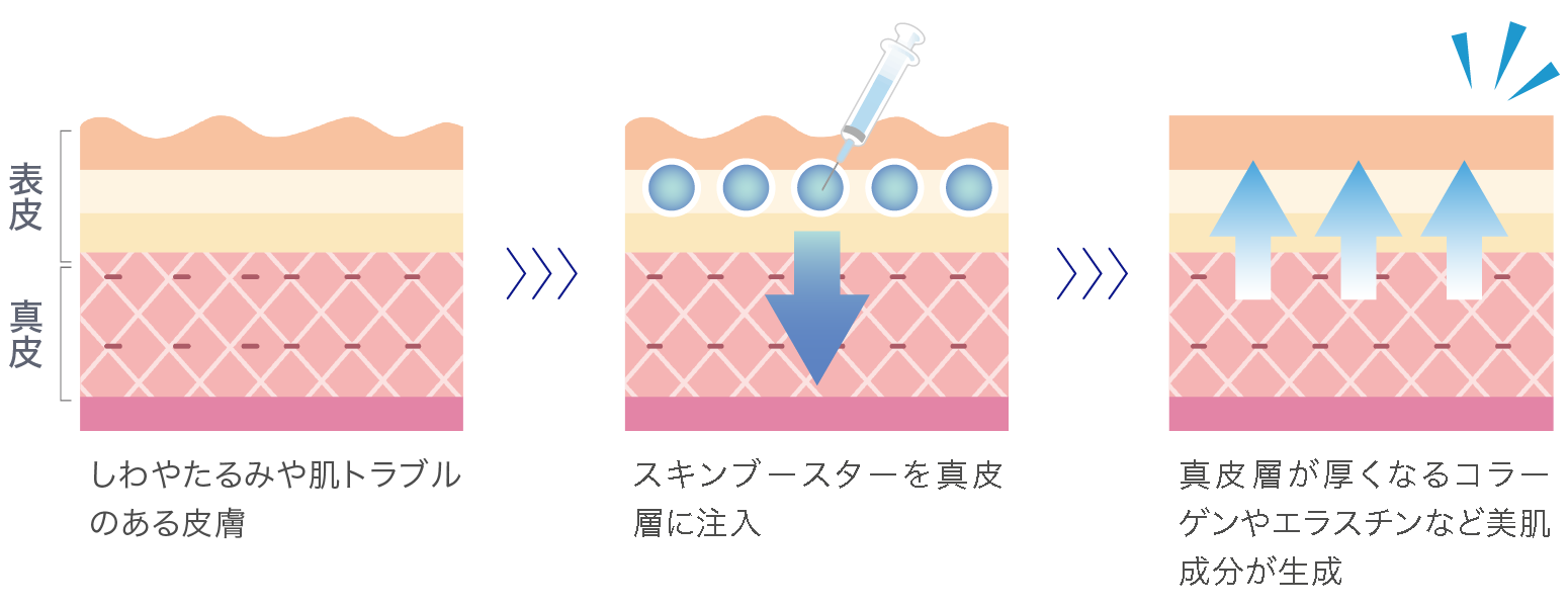 しわやたるみや肌トラブルのある皮膚→スキンブースターを真皮層に注入→真皮層が厚くなるコラーゲンやエラスチンなど美肌成分が生成