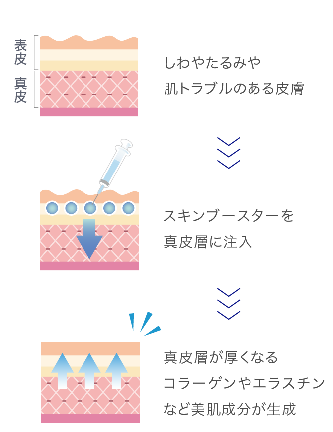 しわやたるみや肌トラブルのある皮膚→スキンブースターを真皮層に注入→真皮層が厚くなるコラーゲンやエラスチンなど美肌成分が生成