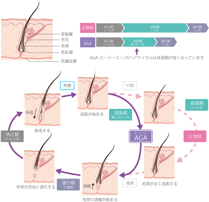 AGAのヘアサイクルは成長期が短くなっています