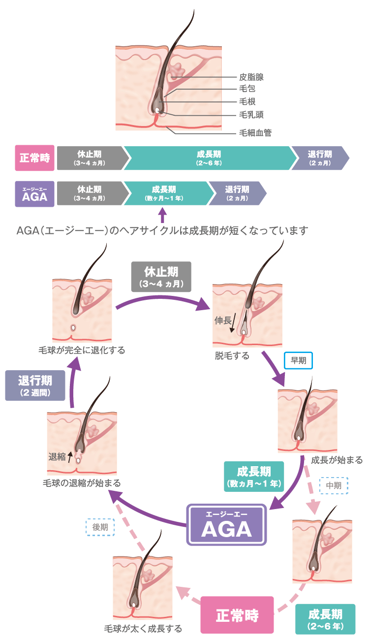 AGAのヘアサイクルは成長期が短くなっています