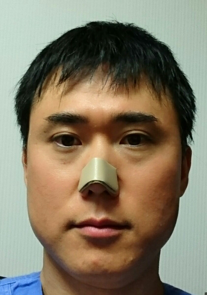 悩みに合わせた鼻尖縮小 だんご鼻修正 手術 高須クリニック