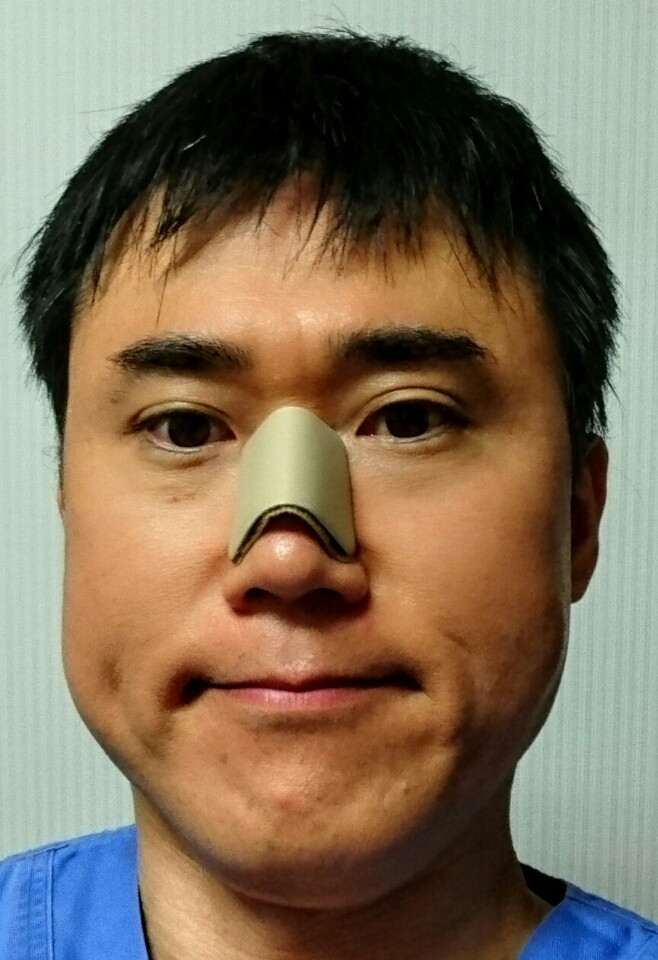 鼻の骨切り幅寄せで太い鼻筋を細く美しい鼻に 美容外科 高須クリニック