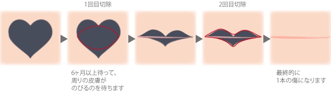 <1回目切除>3~6ヶ月待って、周りの皮膚がのびるのを待ちます <2回目切除>最終的に1本の傷になります