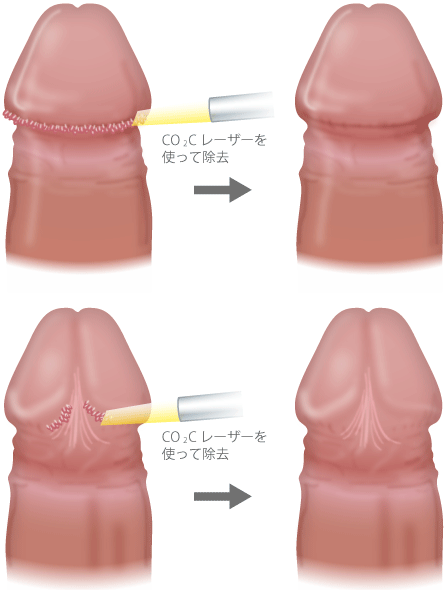 亀頭周囲のぶつぶつ除去