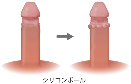 シリコンボール