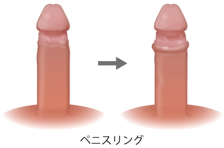 ペニスリング