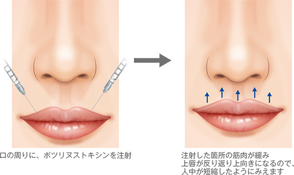 人中短縮ボツリヌストキシン注射の特徴と施術内容：美容外科 高須 