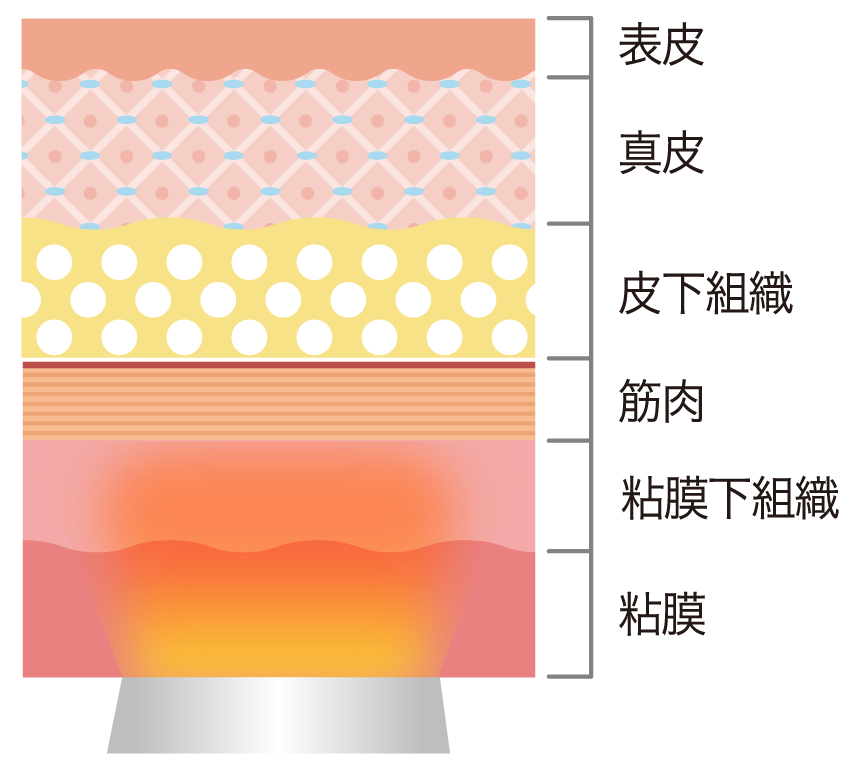 表皮、真皮、皮下組織、筋肉、粘膜下組織、粘膜