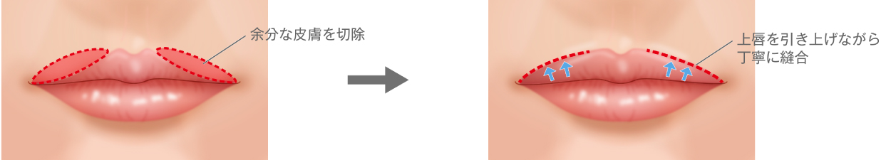 余分な皮膚を切除/上唇を引き上げながら丁寧に縫合