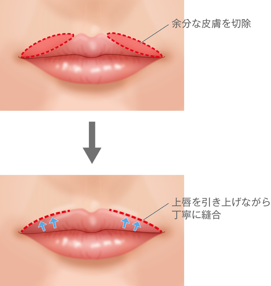 余分な皮膚を切除/上唇を引き上げながら丁寧に縫合