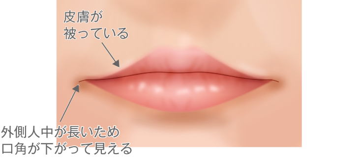 皮膚が被っている/外側人中が長いため口角が下がって見える