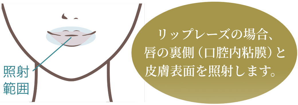 リップレーズの場合､唇の裏側（口腔内粘膜）と皮膚表面を照射します。