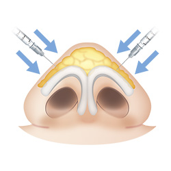 鼻の脂肪溶解注射メソシェイプフェイス