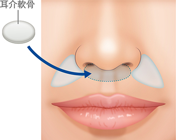 鼻翼基部から鼻中基部にかけて出したい場合は、鼻翼基部プロテーゼ+鼻柱基部耳介軟骨移植を行う場合もあります。