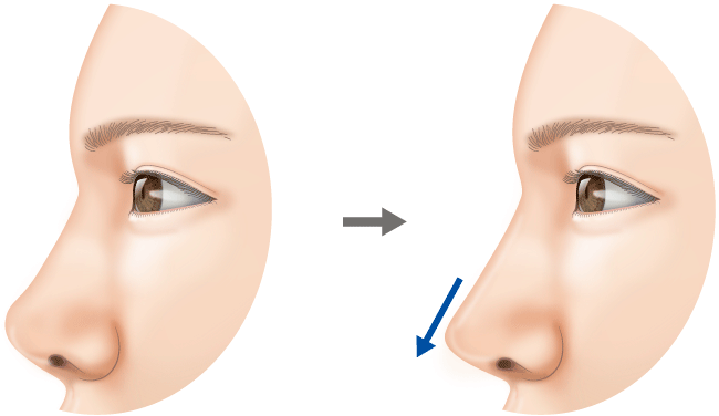 鼻中隔延長：鼻先を大きく下方に延ばします