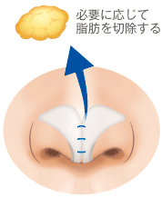 必要に応じて脂肪を切除する