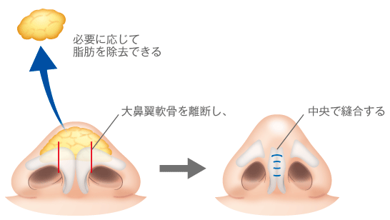 必要に応じて脂肪を除去できる／大鼻翼軟骨を離断し、中央で縫合する