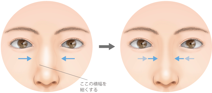 鼻の骨切り幅寄せで太い鼻筋を細く美しい鼻に 高須クリニック