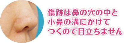 傷跡は鼻の穴の中と小鼻の溝にかけてつくので目立ちません