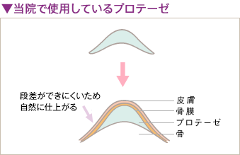当院のシリコンプロテーゼ