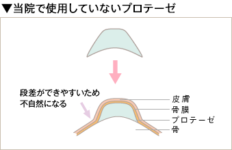 従来のプロテーゼ