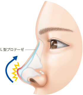 従来のL型プロテーゼ 鼻先の皮膚に負担がかかる。鼻先が上にあがってブタ鼻になりやすい。笑ったときに鼻先があがらないので不自然になる。