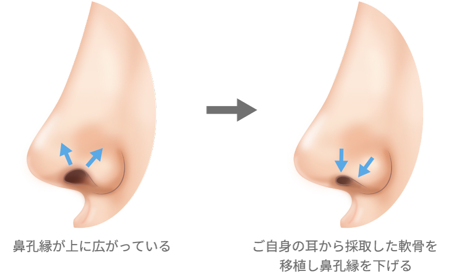 鼻孔縁が上に広がっている/ご自身の耳から採取した軟骨を移植し鼻孔縁を下げる