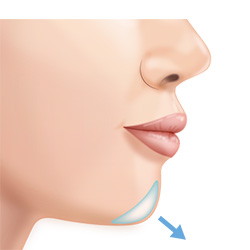 より立体的なEラインをつくる顎プロテーゼ