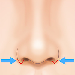 鼻の穴を小さくする鼻翼縮小（小鼻縮小）