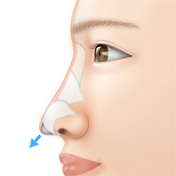 鼻先の悩みを解消する耳介軟骨移植