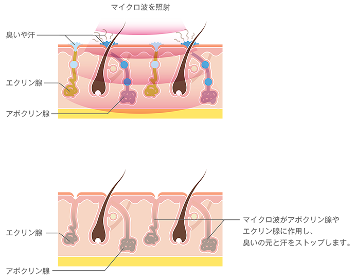 マイクロ波を照射　臭いや汗　エクリン腺　アポクリン腺　マイクロ波がエクリン腺やアポクリン腺に作用し、臭いの元と汗をストップします。