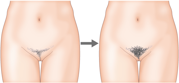 性毛（陰毛）植毛 ： 婦人科・女性器：美容外科 高須クリニック