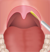 いびき治療（レーザー）