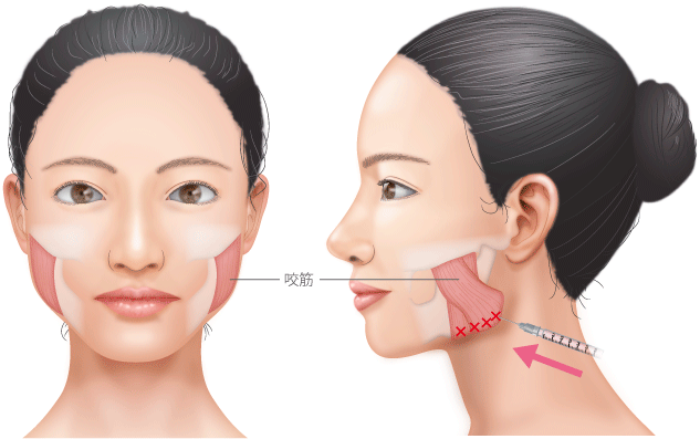 エラボトックス ボツリヌストキシン注射 あご 顎 輪郭 小顔 フェイスライン 美容整形の高須クリニック