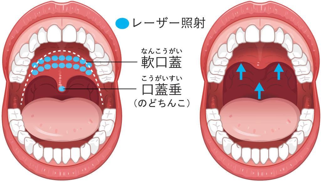 喉の奥（軟口蓋や口蓋垂（のどちんこ））